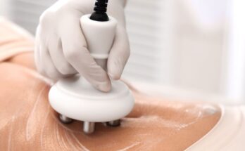 Mi az ultrahangos kavitációs zsírégető terápia?
